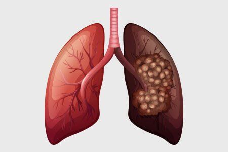 Cáncer de Pulmón: Síntomas, Tipos y Tratamientos